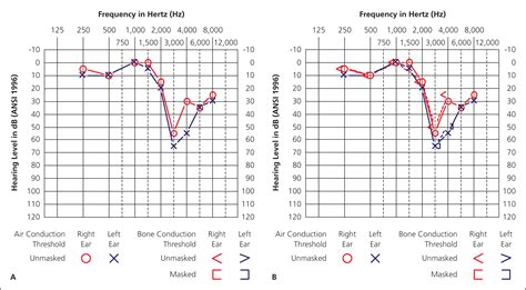 Audiometry Screening and Interpretation .